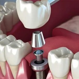 تبلیغ ایمپلنت فوری دروغ است/سلبریتی‌ها حق تبلیغ خدمات پزشکی را ندارند