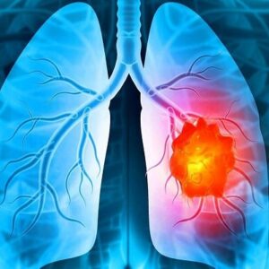 درمان تغییرات ایجادشده در میکروبیوم ریه بر اثر سیگار کشیدن