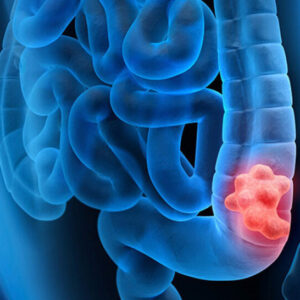 چطور جلوی سرطان روده را بگیریم؟