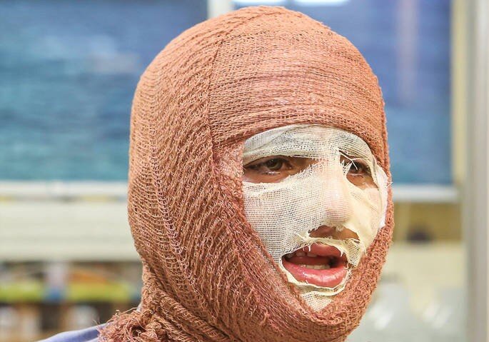 از کمبود تخت تا هزینه‌های سنگین درمان؛ روایت سوختگی در ایران