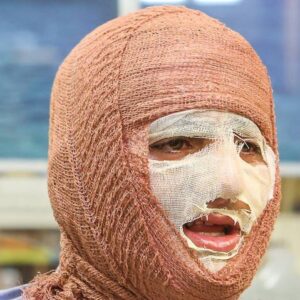 جلالی: سالانه حدود ۳۰۰ هزار نفر به مراکز سوختگی کشور مراجعه می‌کنند