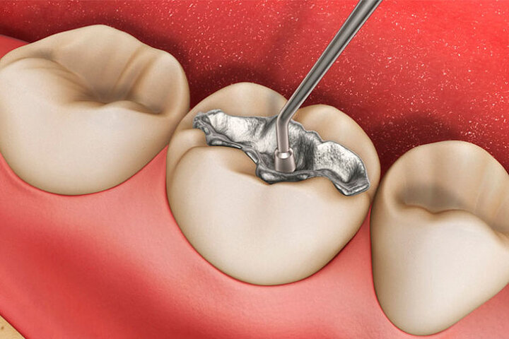پرکردن دندان با آمالگام؛ از مزایا تا معایب آن